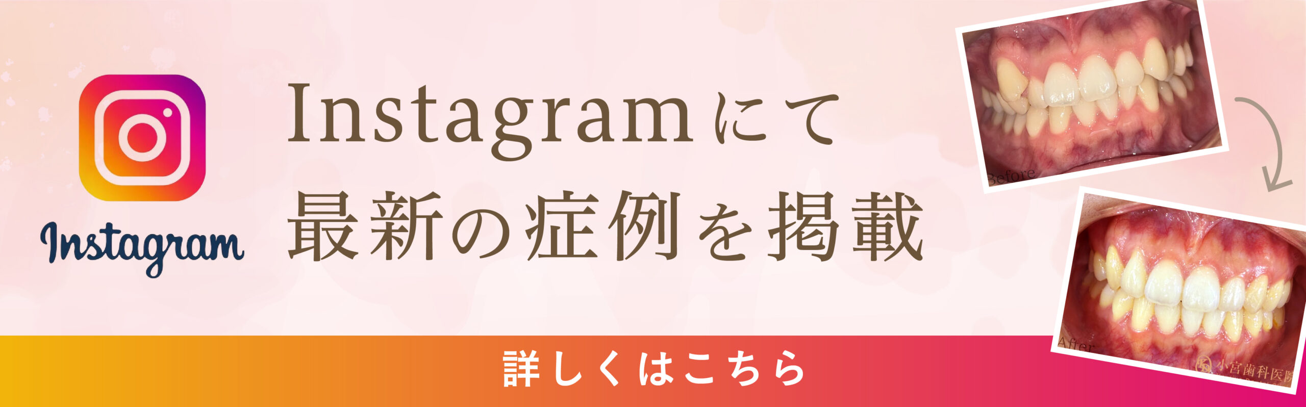 でこぼこ、出っ歯